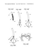 PERCUTANEOUS TRANSVALVULAR INTRAANNULAR BAND FOR MITRAL VALVE REPAIR diagram and image