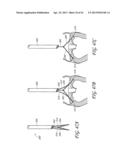 PERCUTANEOUS TRANSVALVULAR INTRAANNULAR BAND FOR MITRAL VALVE REPAIR diagram and image