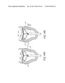 PERCUTANEOUS TRANSVALVULAR INTRAANNULAR BAND FOR MITRAL VALVE REPAIR diagram and image