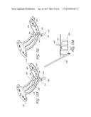 PERCUTANEOUS TRANSVALVULAR INTRAANNULAR BAND FOR MITRAL VALVE REPAIR diagram and image