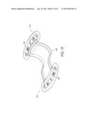 PERCUTANEOUS TRANSVALVULAR INTRAANNULAR BAND FOR MITRAL VALVE REPAIR diagram and image