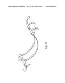 PERCUTANEOUS TRANSVALVULAR INTRAANNULAR BAND FOR MITRAL VALVE REPAIR diagram and image