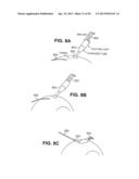 SCLERAL PROSTHESIS FOR TREATING PRESBYOPIA AND OTHER EYE DISORDERS AND     RELATED DEVICES AND METHODS diagram and image