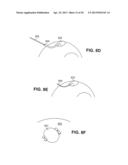 SCLERAL PROSTHESIS FOR TREATING PRESBYOPIA AND OTHER EYE DISORDERS AND     RELATED DEVICES AND METHODS diagram and image