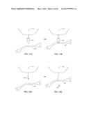 APPARATUS AND METHOD FOR INTRA-ABDOMINALLY MOVING A FIRST INTERNAL ORGAN     TO A POSITION AWAY FROM A SECOND INTERNAL ORGAN AND THEN HOLDING THE     FIRST INTERNAL ORGAN IN THE POSITION WITHOUT MANUAL INPUT diagram and image