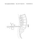 GUIDEWIRE AND METHOD FOR SURGICAL PROCEDURES diagram and image