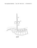 GUIDEWIRE AND METHOD FOR SURGICAL PROCEDURES diagram and image