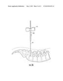 GUIDEWIRE AND METHOD FOR SURGICAL PROCEDURES diagram and image