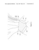 EXTENDED PROTECTION EMBOLIC FILTER diagram and image