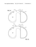 Knee Prosthesis Assembly With Ligament Link diagram and image