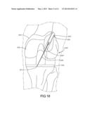 Knee Prosthesis Assembly With Ligament Link diagram and image