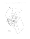 Patient-Specific Glenoid Guide And Implants diagram and image