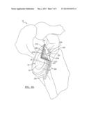 Patient-Specific Glenoid Guide And Implants diagram and image