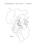 Patient-Specific Glenoid Guide And Implants diagram and image