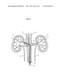 APPARATUS AND METHOD FOR RADIATION TREATMENT OF A DESIRED AREA IN THE     RENAL VASCULAR SYSTEM OF A PATIENT diagram and image