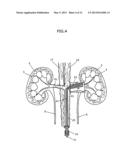 APPARATUS AND METHOD FOR RADIATION TREATMENT OF A DESIRED AREA IN THE     RENAL VASCULAR SYSTEM OF A PATIENT diagram and image