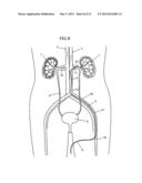 APPARATUS AND METHOD FOR RADIATION TREATMENT OF A DESIRED AREA IN THE     RENAL VASCULAR SYSTEM OF A PATIENT diagram and image