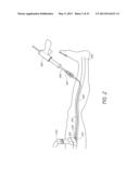 ENHANCED ULTRASOUND VISUALIZATION OF INTRAVASCULAR DEVICES diagram and image