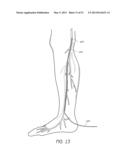 ENHANCED ULTRASOUND VISUALIZATION OF INTRAVASCULAR DEVICES diagram and image