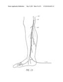 ENHANCED ULTRASOUND VISUALIZATION OF INTRAVASCULAR DEVICES diagram and image