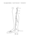 ENHANCED ULTRASOUND VISUALIZATION OF INTRAVASCULAR DEVICES diagram and image