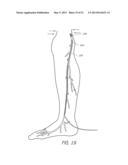 ENHANCED ULTRASOUND VISUALIZATION OF INTRAVASCULAR DEVICES diagram and image