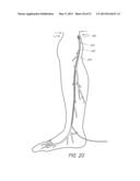 ENHANCED ULTRASOUND VISUALIZATION OF INTRAVASCULAR DEVICES diagram and image