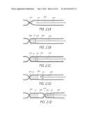 ENHANCED ULTRASOUND VISUALIZATION OF INTRAVASCULAR DEVICES diagram and image