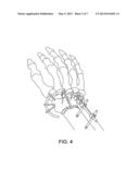 EXTERNAL FIXATION diagram and image