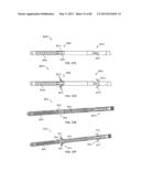 STRAIGHT INTRAMEDULLARY FRACTURE FIXATION DEVICES AND METHODS diagram and image