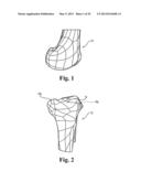 DEVICES AND METHODS FOR PERFORMING KNEE ARTHROPLASTY diagram and image