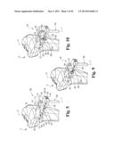 DEVICES AND METHODS FOR PERFORMING KNEE ARTHROPLASTY diagram and image