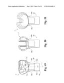 DEVICES AND METHODS FOR PERFORMING KNEE ARTHROPLASTY diagram and image