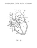 SINGLE-CHAMBER LEADLESS INTRA-CARDIAC MEDICAL DEVICE WITH DUAL-CHAMBER     FUNCTIONALITY AND SHAPED STABILIZATION INTRA-CARDIAC EXTENSION diagram and image