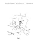 MEDICAL DEVICE CONTACT ASSEMBLIES FOR USE WITH IMPLANTABLE LEADS, AND     ASSOCIATED SYSTEMS AND METHODS diagram and image