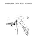 SURGICAL INSTRUMENTATION ASSEMBLY FOR POSITIONING AN ANKLE PROSTHESIS diagram and image