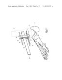 SURGICAL INSTRUMENTATION ASSEMBLY FOR POSITIONING AN ANKLE PROSTHESIS diagram and image