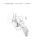 SURGICAL INSTRUMENTATION ASSEMBLY FOR POSITIONING AN ANKLE PROSTHESIS diagram and image