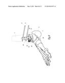 SURGICAL INSTRUMENTATION ASSEMBLY FOR POSITIONING AN ANKLE PROSTHESIS diagram and image