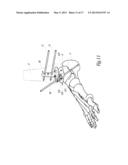 SURGICAL INSTRUMENTATION ASSEMBLY FOR POSITIONING AN ANKLE PROSTHESIS diagram and image