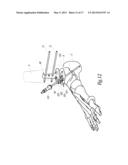 SURGICAL INSTRUMENTATION ASSEMBLY FOR POSITIONING AN ANKLE PROSTHESIS diagram and image