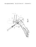 SURGICAL INSTRUMENTATION ASSEMBLY FOR POSITIONING AN ANKLE PROSTHESIS diagram and image