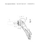 SURGICAL INSTRUMENTATION ASSEMBLY FOR POSITIONING AN ANKLE PROSTHESIS diagram and image