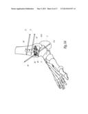 SURGICAL INSTRUMENTATION ASSEMBLY FOR POSITIONING AN ANKLE PROSTHESIS diagram and image