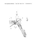 SURGICAL INSTRUMENTATION ASSEMBLY FOR POSITIONING AN ANKLE PROSTHESIS diagram and image