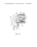 MAGNETIC IMPLANTS AND METHODS FOR TREATING AN OROPHARYNGEAL CONDITION diagram and image