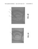 3D INTRAORAL MEASUREMENTS USING OPTICAL MULTILINE METHOD diagram and image