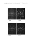 Non-Contrast-Enhanced 4D MRA Using Compressed Sensing Reconstruction diagram and image