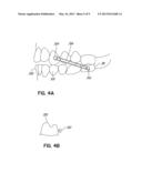 DIRECT MANUFACTURE OF ORTHODONTIC ALIGNER APPLIANCE diagram and image