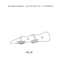 ARTHRODESIS IMPLANT AND BUTTRESSING APPARATUS AND METHOD diagram and image